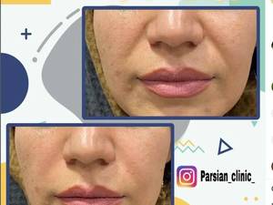 بهترین کلینک تزریق فیلر خط خنده