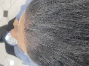 روش میکرواسکالپ سر مناسب چه کسانی می باشد