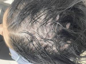 روش میکرواسکالپ سر مناسب چه کسانی می باشد