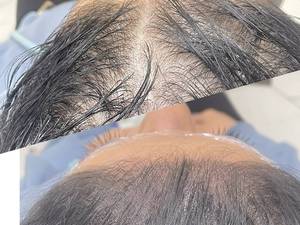 روش میکرواسکالپ سر مناسب چه کسانی می باشد
