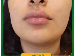 تزریق ژل لب