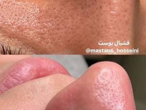هزینه پاکسازی پوست در پاکدشت