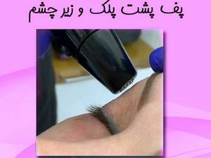 بهترین درمان پف زیر چشم و پشت پلک در رشت
