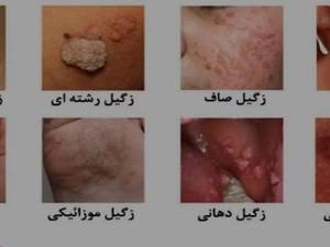 درمان زگیل تناسلی در رشت