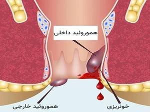بهترین دکتر برای درمان هموروئید در رشت