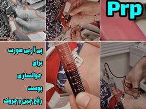 قیمت پی آر پی و جوانسازی در رشت