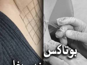 قیمت بوتاکس زیر بغل در تهران
