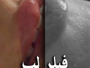 بهترین مرکز فیلر لب در تهران