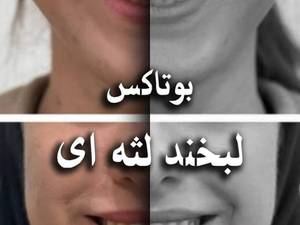درمان لبخند لثه ای با بوتاکس در تهران