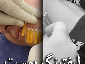 تزریق نخ مونو کلاژن ساز جوان ساز در تهران
