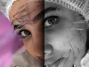 اجرای طب سوزنی در تهران 