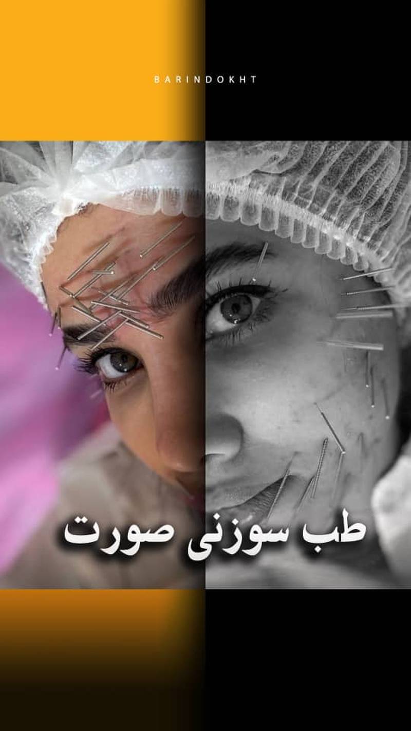 اجرای طب سوزنی در تهران