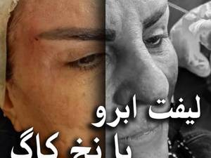 قیمت لیفت ابرو با نخ در تهران