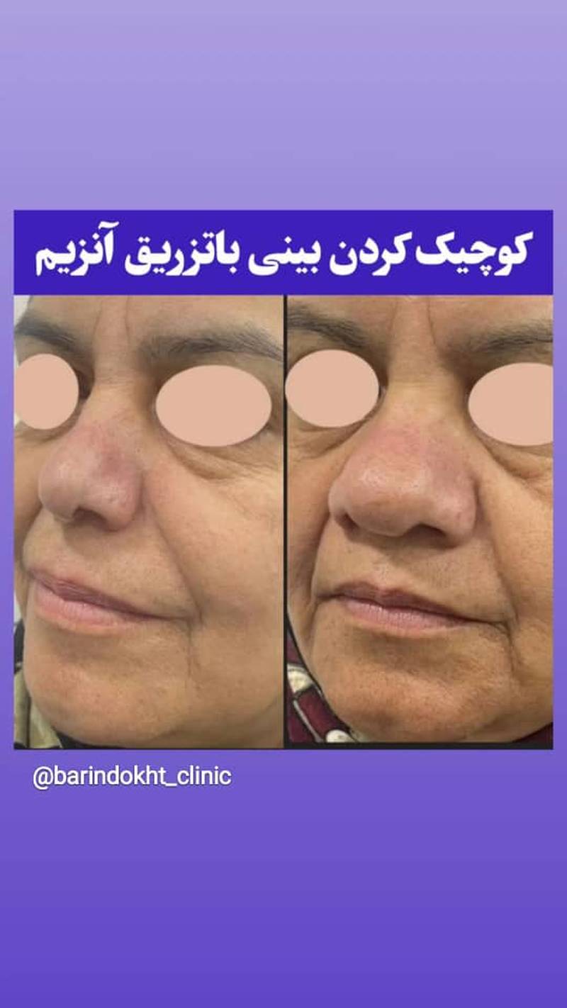 کوچک کردن بینی با تزریق آنزیم