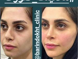 قیمت مادلینگ و لیفت صورت در تهران