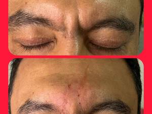 هزینه تزریق بوتاکس پیشانی در تهران
