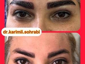 کاشت ابرو طبیعی در تهران