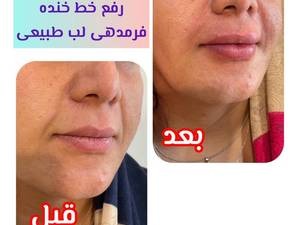 رفع خط خنده و فرم دهی لب طبیعی در تهران