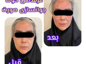 هزینه فرم دهی گونه و جوانسازی صورت در تهران