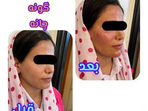 قیمت فرم دهی چانه و زاویه سازی صورت در تهران