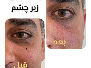 رفع گودی زیر چشم بدون درد در تهران