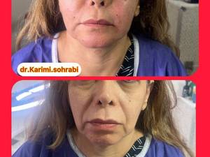 بهترین دکتر تزریق چربی و جوانسازی در تهران