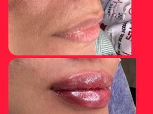 بهترین مرکز تزریق ژل لب در تهران