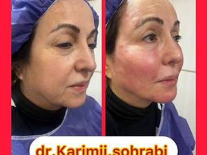 تزریق چربی به کل صورت و رفع چروک پوستی