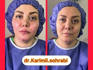 قیمت مادلینگ صورت با تزریق چربی در تهران