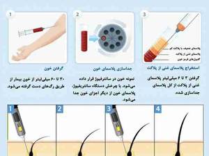 prp) Platelete Rich Plasma) پلاسمای غنی از پلاكت