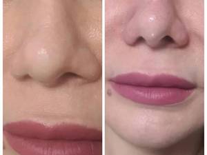کوچک کردن بینی بدون جراحی با تزریق انزیم
