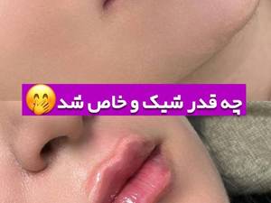 تزریق ژل لب طبیعی در تهران با ماندگاری بالا