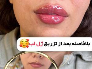 مرکز تزریق ژل طبیعی در پاسداران تهران