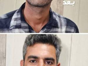 بهترین مرکز بوتاکس در بوشهر