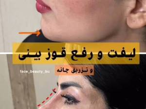لیفت و رفع قوز بینی در بوشهر