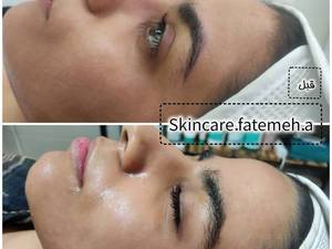کربوکسی تراپی در اهواز