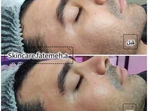 کربوکسی تراپی صورت در اهواز