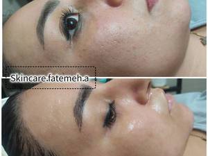 پاکسازی عمیق و تخصصی پوست در خوزستان