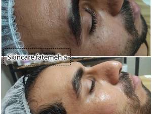 کربوکسی تراپی کره ای در اهواز