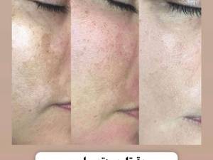 بهترین دمنوش از بین برنده لک صورت