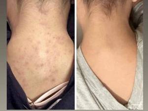 بهترین دمنوش از بین برنده لک صورت