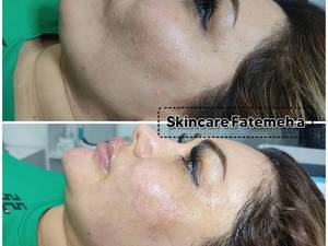 پاکسازی تخصصی پوست در اهواز