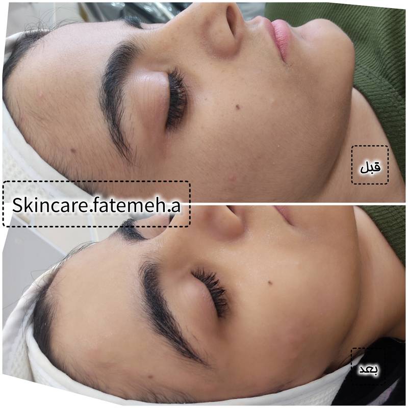 هزینه پاکسازی پوست جوش دار در اهواز