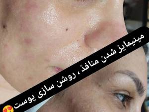 رفع تیرگی پوست در اهواز