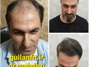 کاشت مو با تراکم بالا در رشت