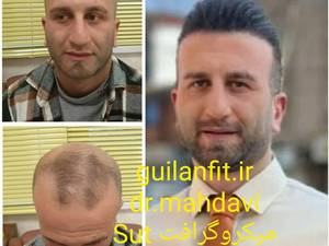 کاشت مو بدون جراحی در رشت