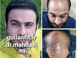 کاشت مو بدون درد در رشت