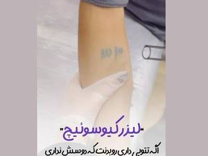 هزینه پاك كردن تاتو با ليزر در لاهیجان