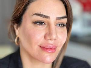 بهترین دکتر تزریق ژل در لاهیجان