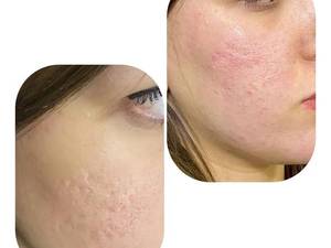 میکرونیدلینگ تخصصی کرمانشاه